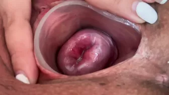 Small cervix without dilating